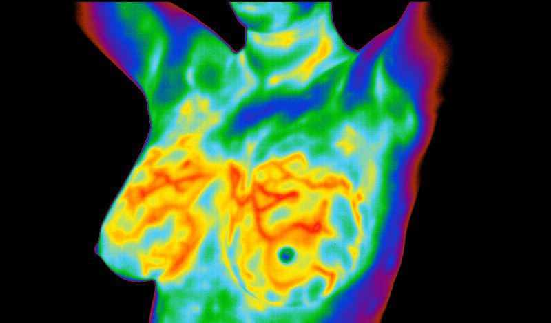 Breast Thermography